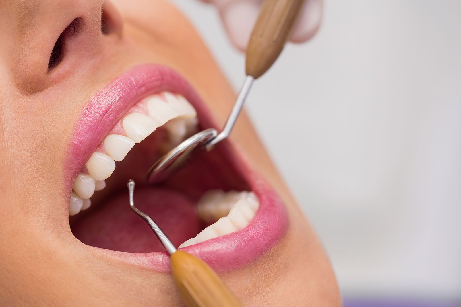 Gizli Diş Çürüğü: Belirtileri, Tedavisi ve Önlenmesi